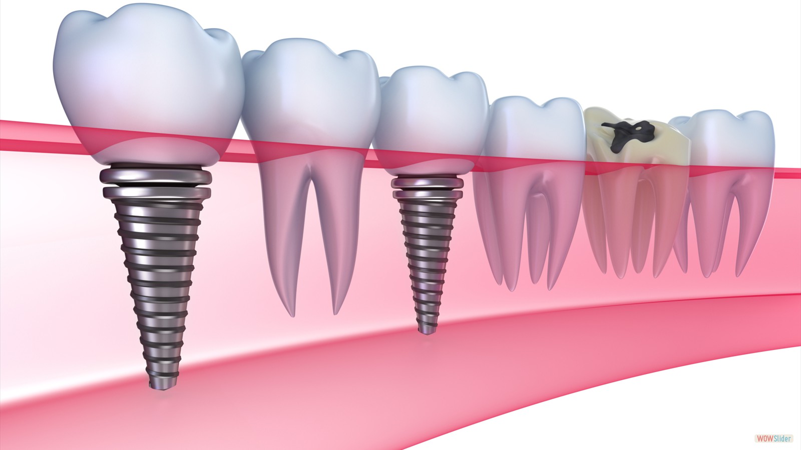 dental-implants-illustration